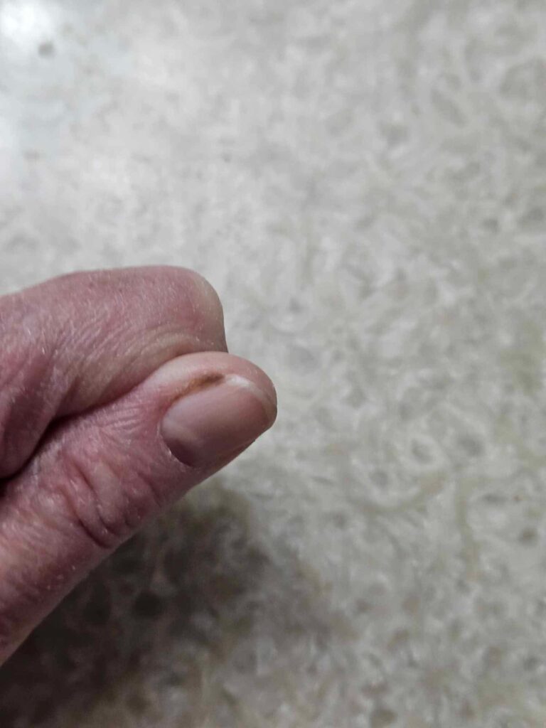 Image of a thumb with a dark streak under thumbnail and dark mass growing at its edge (undiagnosed melanoma)