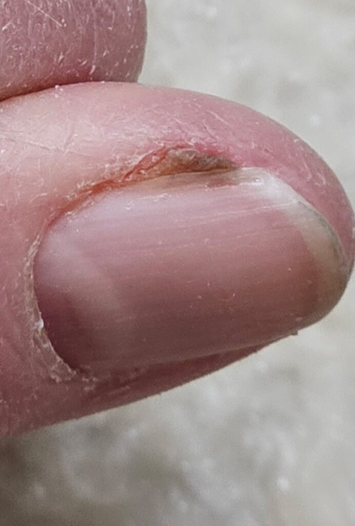 Image of a thumb with a dark streak under thumbnail and dark mass growing at its edge (undiagnosed melanoma)