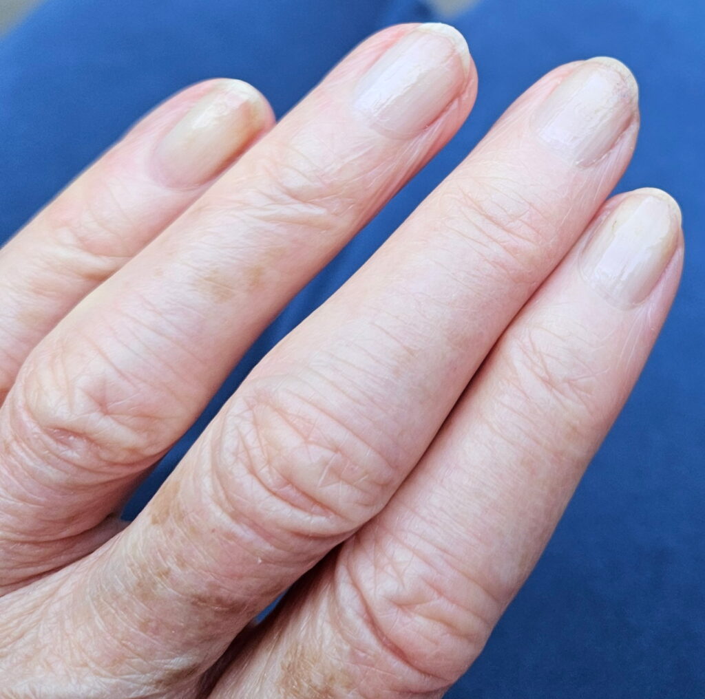 Image of a hand that suffered from Raynaud's syndrome 2.5 years AFTER using H2 sessions