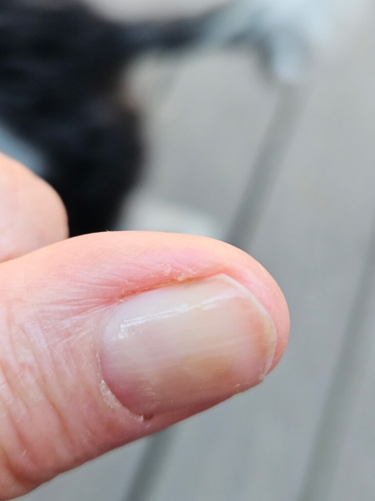 The thumb after over 2 years from Molecular Hydrogen (H₂) Targeted Sessions