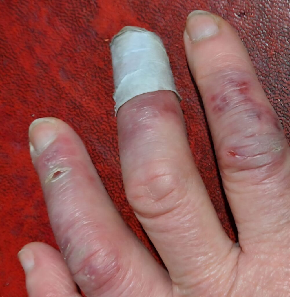 Image of a hand suffering from Raynaud's syndrome with ulcers and splits in fingers