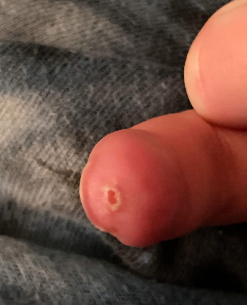 Image of a finger with ulcers suffering from Raynaud's syndrome