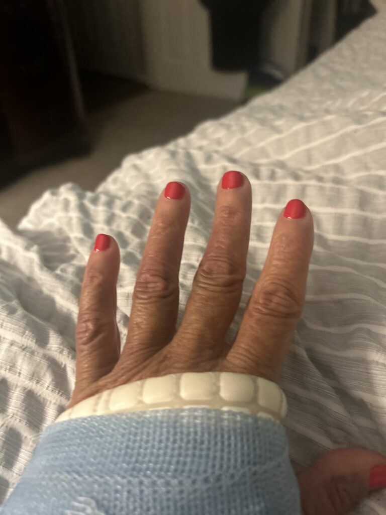 Image of left hand index with lower metacarpal fracture AFTER 1st Molecular Hydrogen (H₂) Targeted Session