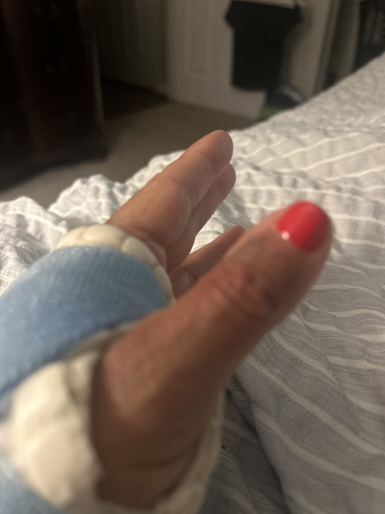 Image of left hand thumb and the left index with lower metacarpal fracture AFTER 1st Molecular Hydrogen (H₂) Targeted Session