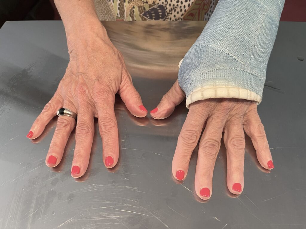 Image of two hands, left hand index with lower metacarpal fracture AFTER 2nd Molecular Hydrogen (H₂) Targeted Session