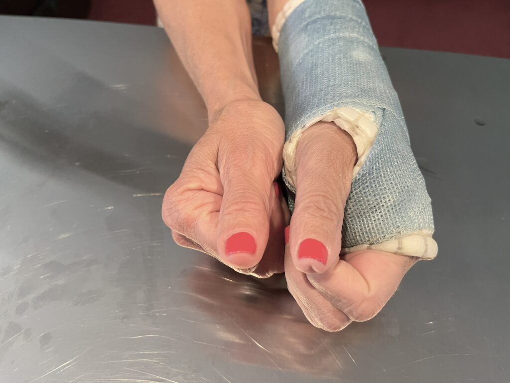 Image of two hands, with the left hand index finger lower metacarpal fracture and left thumb AFTER 2nd Molecular Hydrogen (H₂) Targeted Session