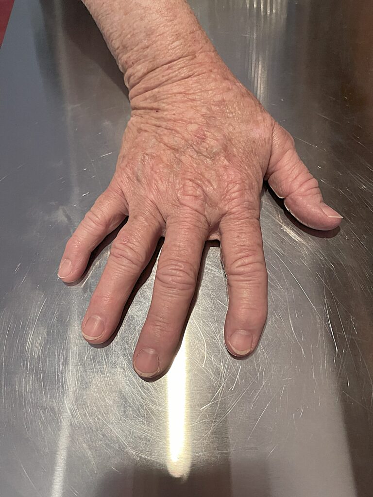 Image of Arthritis Right hand palm down BEFORE first Molecular Hydrogen (H₂) Targeted Sessions