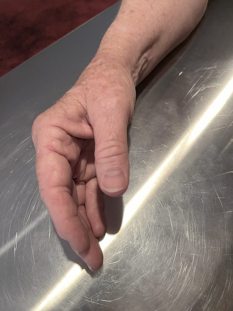 Image of Arthritis Right hand thumb, side, BEFORE first Molecular Hydrogen (H₂) Targeted Sessions